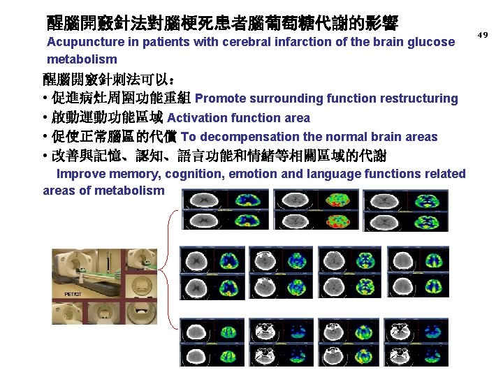 醒腦開竅針法對腦梗死患者腦葡萄糖代謝的影響 Acupuncture in patients with cerebral infarction of the brain glucose metabolism 醒腦開竅針刺法可以： •