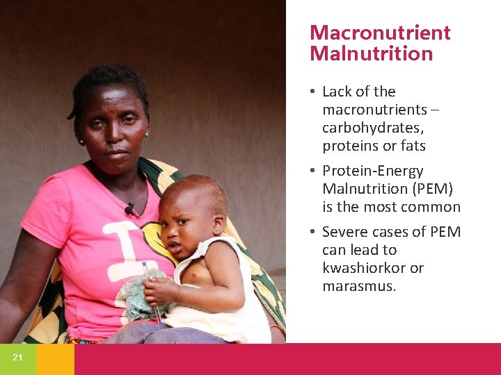 Macronutrient Malnutrition • Lack of the macronutrients – carbohydrates, proteins or fats • Protein-Energy