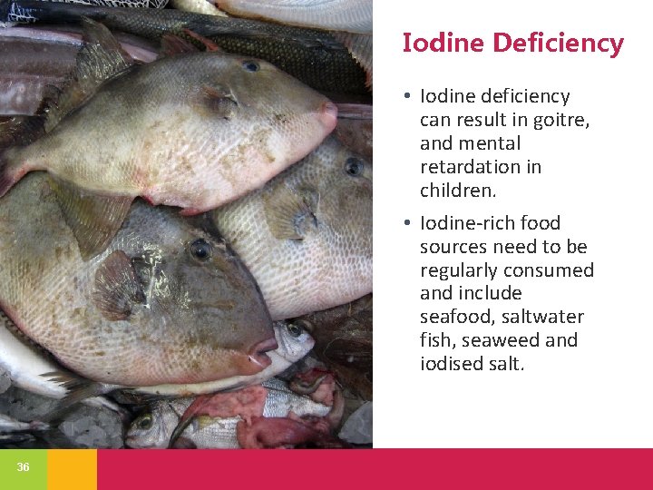 Iodine Deficiency • Iodine deficiency can result in goitre, and mental retardation in children.