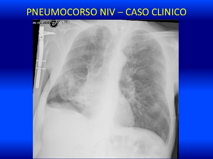 PNEUMOCORSO NIV – CASO CLINICO 