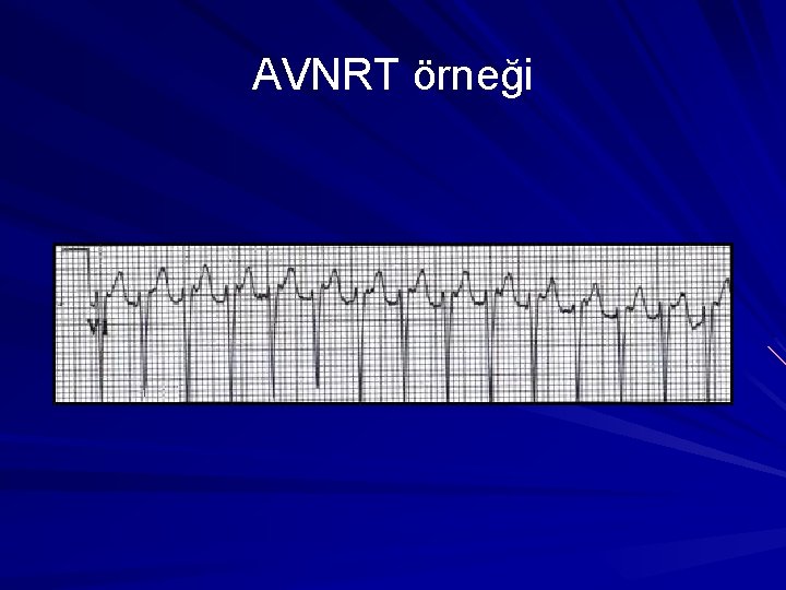 AVNRT örneği AVNRT örneği