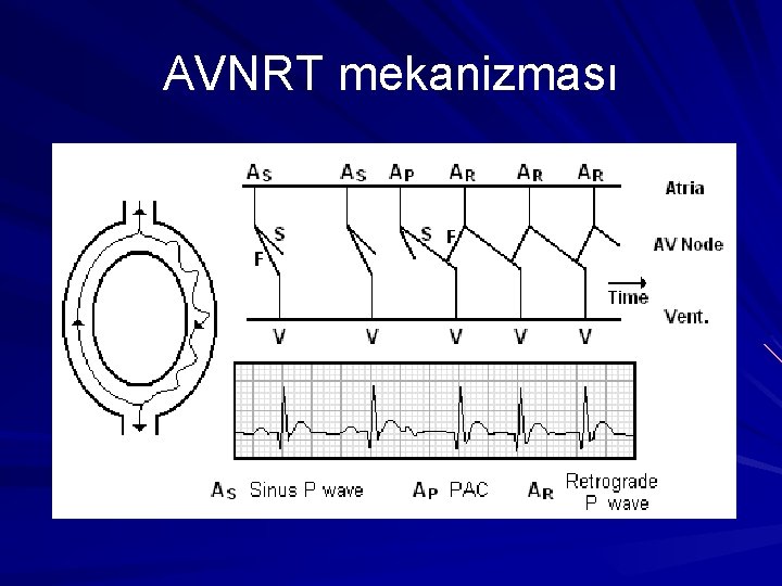 AVNRT mekanizması AVNRT mekanizması