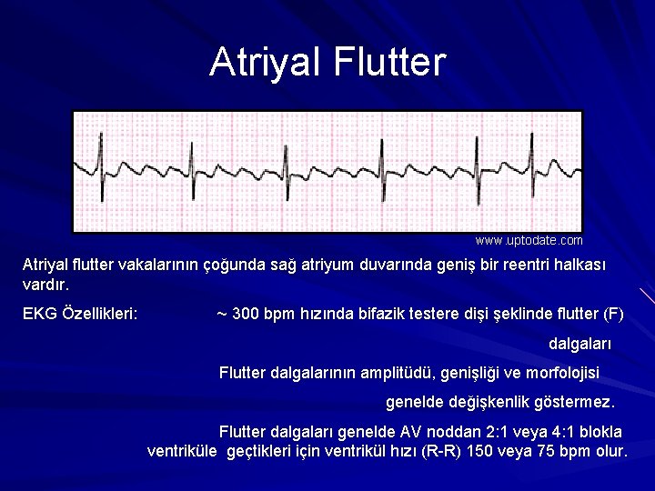 Atriyal Flutter www. uptodate. com Atriyal flutter vakalarının çoğunda sağ atriyum duvarında geniş bir Atriyal Flutter www. uptodate. com Atriyal flutter vakalarının çoğunda sağ atriyum duvarında geniş bir