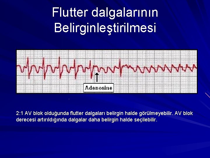 Flutter dalgalarının Belirginleştirilmesi . 2: 1 AV blok olduğunda flutter dalgaları belirgin halde görülmeyebilir. Flutter dalgalarının Belirginleştirilmesi . 2: 1 AV blok olduğunda flutter dalgaları belirgin halde görülmeyebilir.