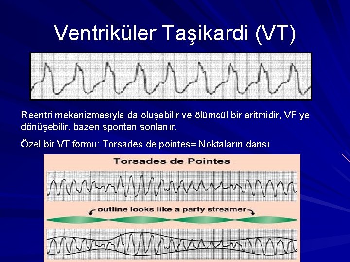 Ventriküler Taşikardi (VT) Reentri mekanizmasıyla da oluşabilir ve ölümcül bir aritmidir, VF ye dönüşebilir, Ventriküler Taşikardi (VT) Reentri mekanizmasıyla da oluşabilir ve ölümcül bir aritmidir, VF ye dönüşebilir,