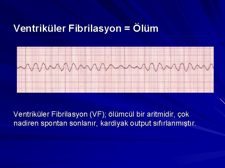 Ventriküler Fibrilasyon = Ölüm Ventriküler Fibrilasyon (VF); ölümcül bir aritmidir, çok nadiren spontan sonlanır, Ventriküler Fibrilasyon = Ölüm Ventriküler Fibrilasyon (VF); ölümcül bir aritmidir, çok nadiren spontan sonlanır,