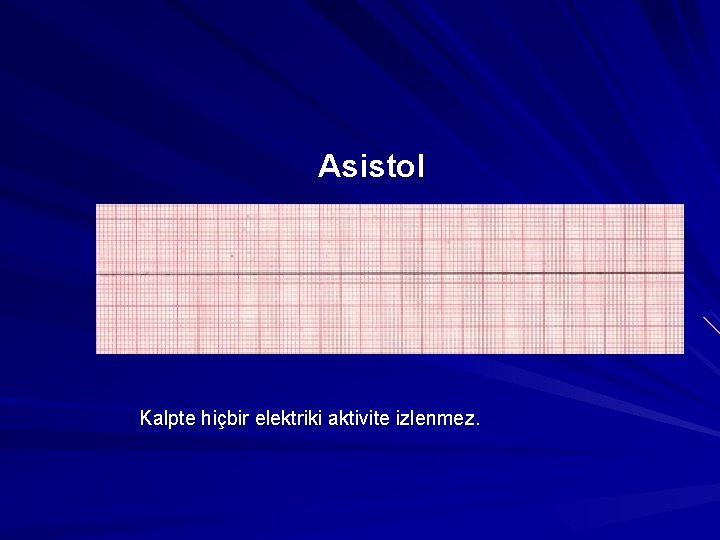 Asistol Kalpte hiçbir elektriki aktivite izlenmez. Asistol Kalpte hiçbir elektriki aktivite izlenmez.