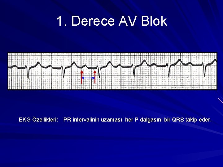 1. Derece AV Blok EKG Özellikleri: PR intervalinin uzaması; her P dalgasını bir QRS 1. Derece AV Blok EKG Özellikleri: PR intervalinin uzaması; her P dalgasını bir QRS