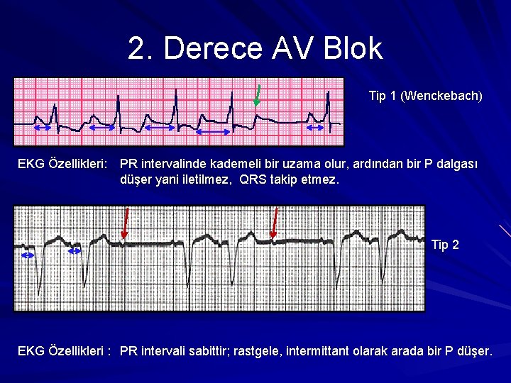 2. Derece AV Blok Tip 1 (Wenckebach) EKG Özellikleri: PR intervalinde kademeli bir uzama 2. Derece AV Blok Tip 1 (Wenckebach) EKG Özellikleri: PR intervalinde kademeli bir uzama