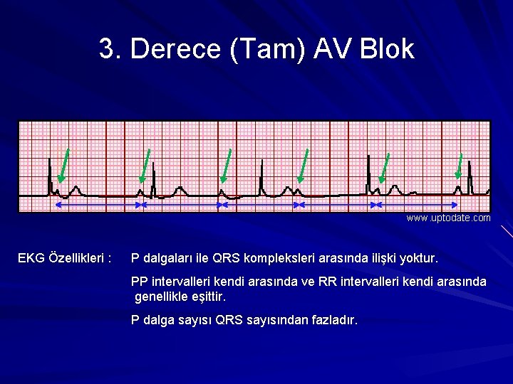 3. Derece (Tam) AV Blok www. uptodate. com EKG Özellikleri : P dalgaları ile 3. Derece (Tam) AV Blok www. uptodate. com EKG Özellikleri : P dalgaları ile