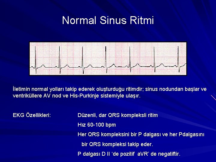 Normal Sinus Ritmi İletimin normal yolları takip ederek oluşturduğu ritimdir; sinus nodundan başlar ve Normal Sinus Ritmi İletimin normal yolları takip ederek oluşturduğu ritimdir; sinus nodundan başlar ve