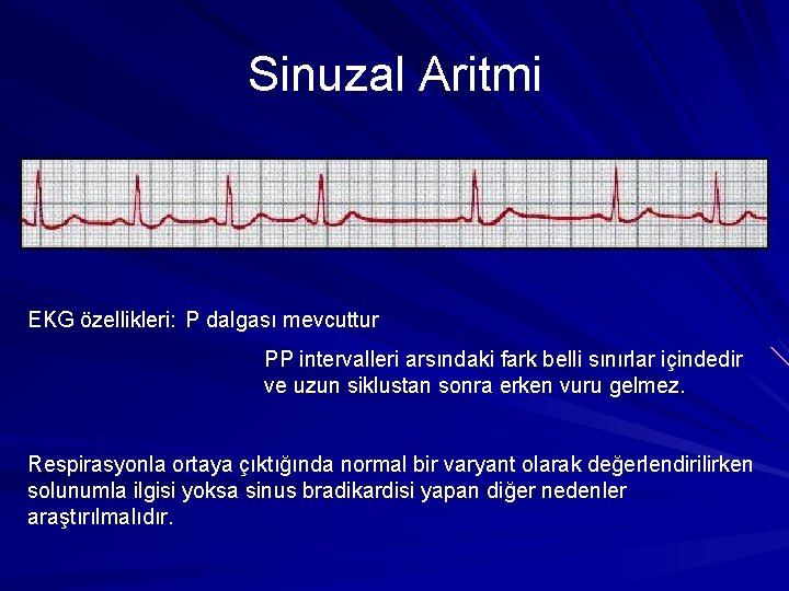 Sinuzal Aritmi EKG özellikleri: P dalgası mevcuttur PP intervalleri arsındaki fark belli sınırlar içindedir Sinuzal Aritmi EKG özellikleri: P dalgası mevcuttur PP intervalleri arsındaki fark belli sınırlar içindedir