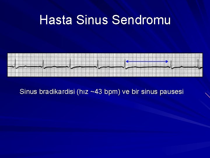 Hasta Sinus Sendromu Sinus bradikardisi (hız ~43 bpm) ve bir sinus pausesi Hasta Sinus Sendromu Sinus bradikardisi (hız ~43 bpm) ve bir sinus pausesi