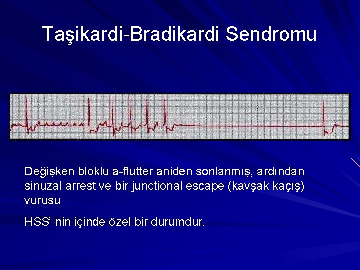 Taşikardi-Bradikardi Sendromu Değişken bloklu a-flutter aniden sonlanmış, ardından sinuzal arrest ve bir junctional escape Taşikardi-Bradikardi Sendromu Değişken bloklu a-flutter aniden sonlanmış, ardından sinuzal arrest ve bir junctional escape