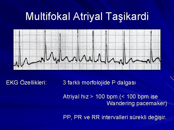Multifokal Atriyal Taşikardi EKG Özellikleri: 3 farklı morfolojide P dalgası Atriyal hız > 100 Multifokal Atriyal Taşikardi EKG Özellikleri: 3 farklı morfolojide P dalgası Atriyal hız > 100