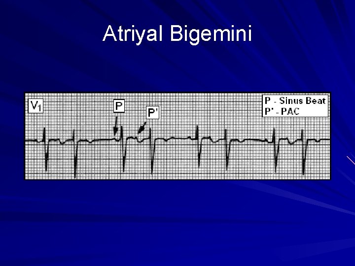 Atriyal Bigemini Atriyal Bigemini
