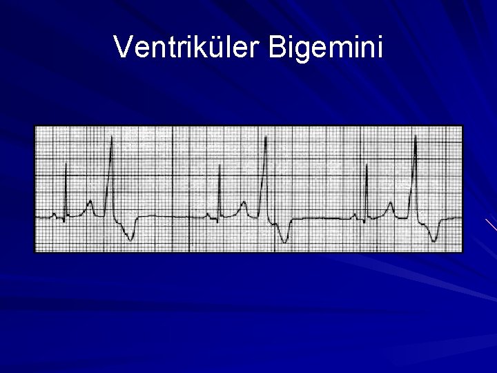 Ventriküler Bigemini Ventriküler Bigemini