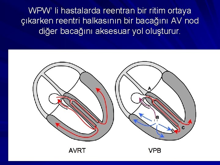 WPW’ li hastalarda reentran bir ritim ortaya çıkarken reentri halkasının bir bacağını AV nod WPW’ li hastalarda reentran bir ritim ortaya çıkarken reentri halkasının bir bacağını AV nod