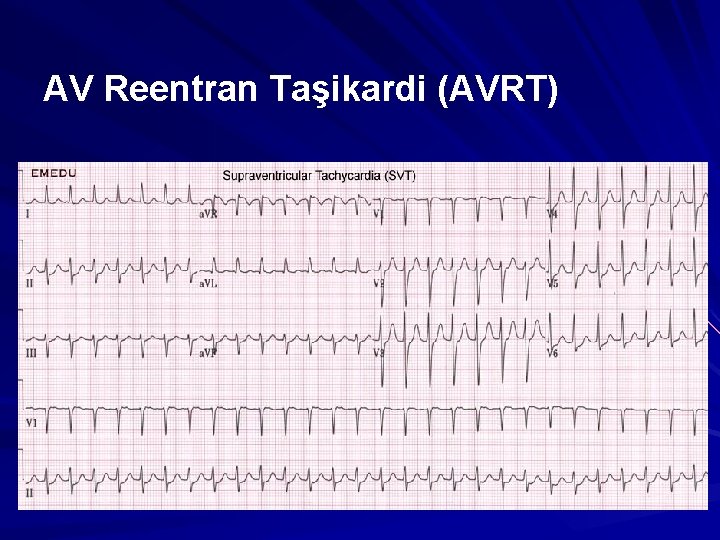 AV Reentran Taşikardi (AVRT) AV Reentran Taşikardi (AVRT)