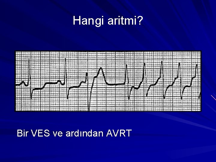 Hangi aritmi? Bir VES ve ardından AVRT Hangi aritmi? Bir VES ve ardından AVRT