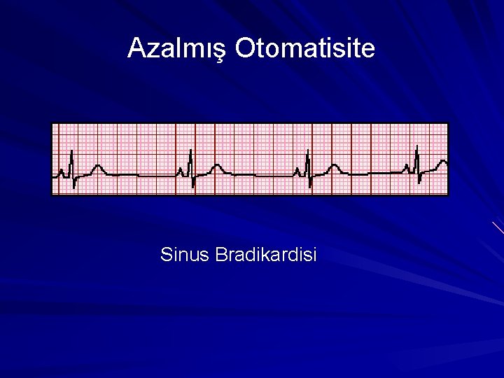 Azalmış Otomatisite Sinus Bradikardisi Azalmış Otomatisite Sinus Bradikardisi