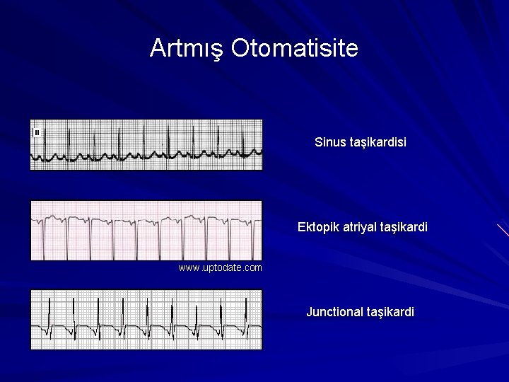 Artmış Otomatisite Sinus taşikardisi Ektopik atriyal taşikardi www. uptodate. com Junctional taşikardi Artmış Otomatisite Sinus taşikardisi Ektopik atriyal taşikardi www. uptodate. com Junctional taşikardi