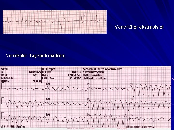 Ventriküler ekstrasistol Ventriküler Taşikardi (nadiren) Ventriküler ekstrasistol Ventriküler Taşikardi (nadiren)