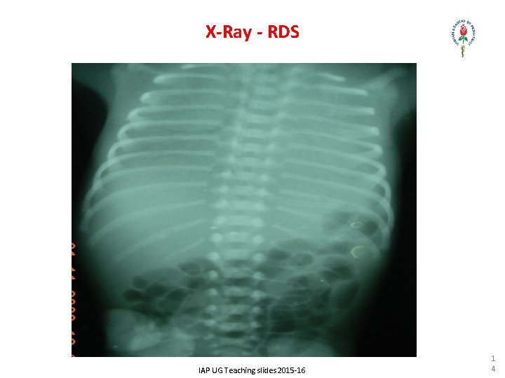 X-Ray - RDS IAP UG Teaching slides 2015 -16 1 4 