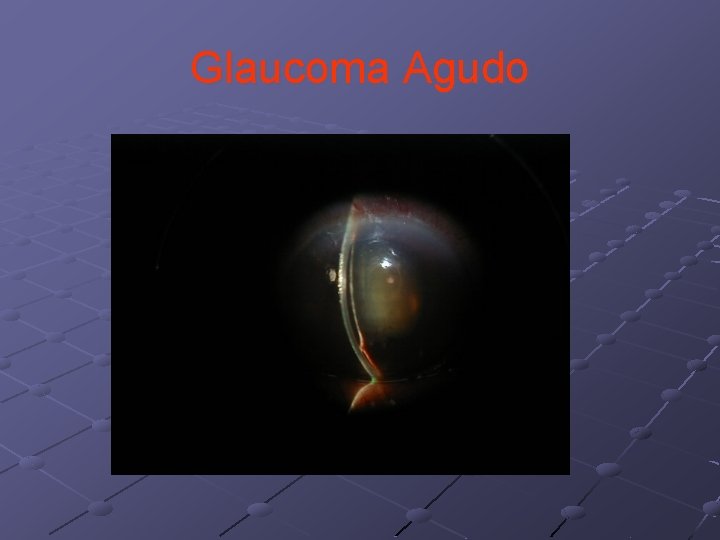 Glaucoma Agudo 