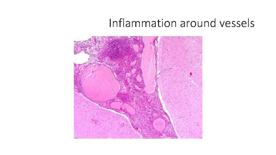 Inflammation around vessels 