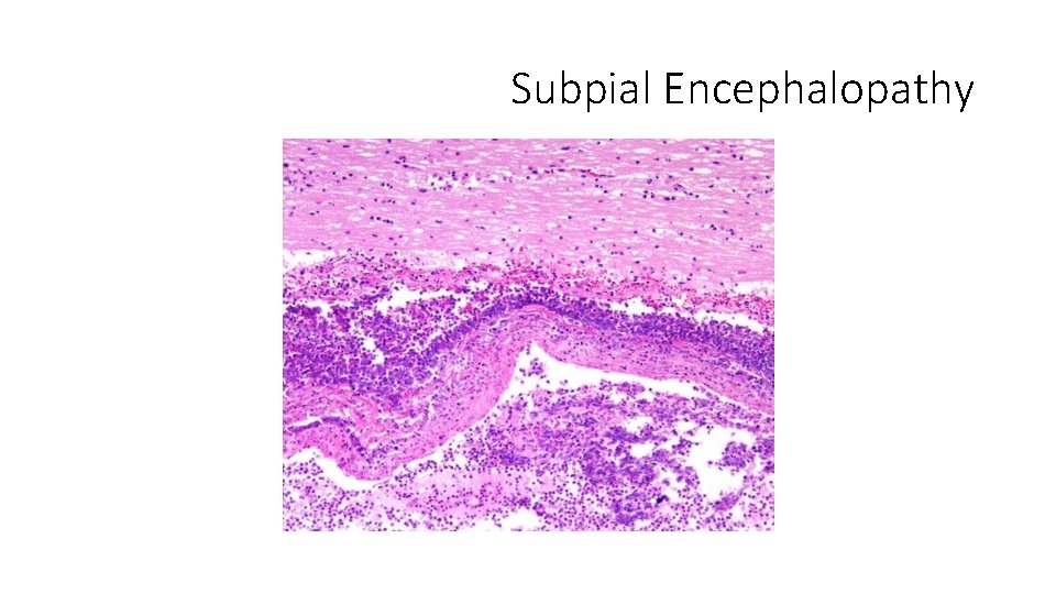 Subpial Encephalopathy 