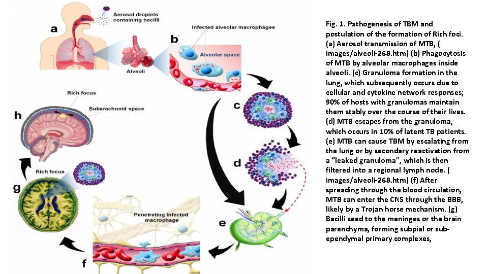 Fig. 1. Pathogenesis of TBM and postulation of the formation of Rich foci. (a)