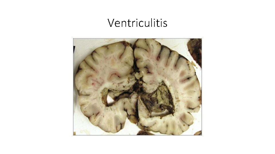 Ventriculitis 