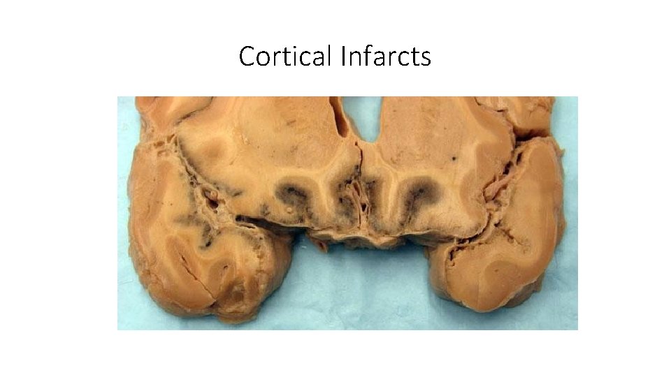 Cortical Infarcts 