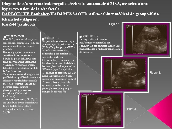 Diagnostic d’une ventriculomégalie cérébrale anténatale à 21 SA, associée à une hyperextension de la