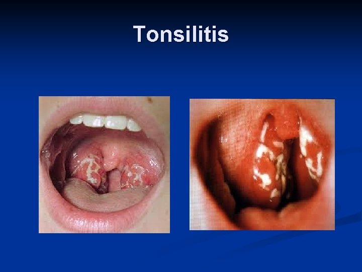 Tonsilitis 