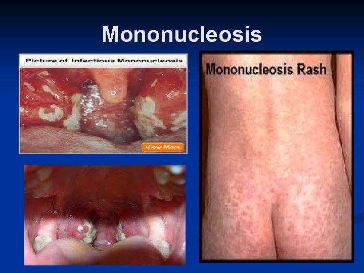 Mononucleosis 