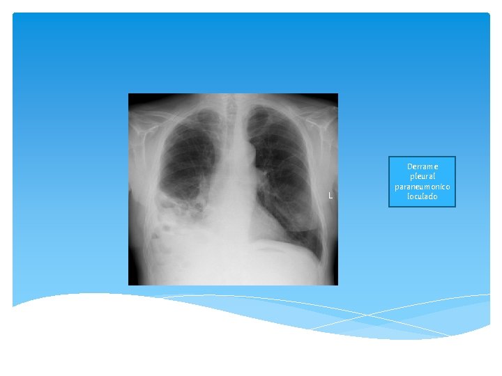 Derrame pleural paraneumonico loculado 