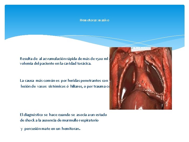 Hemotorax masivo Resulta de al acvumulación rápida de más de 1500 ml de sangre