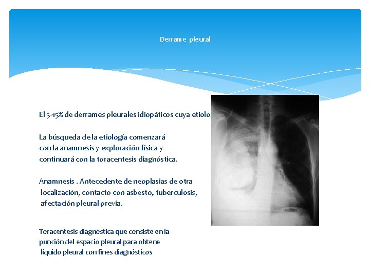 Derrame pleural El 5 -15% de derrames pleurales idiopáticos cuya etiología es desconocida. La