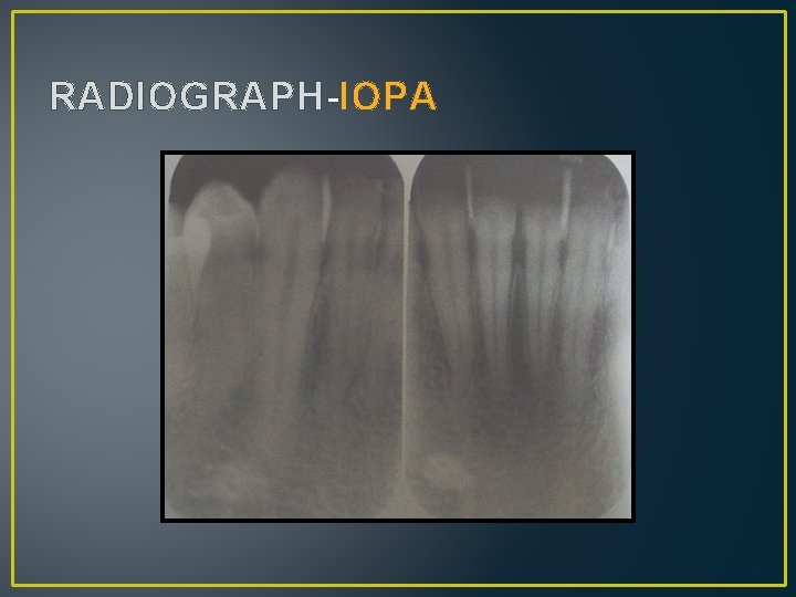 RADIOGRAPH-IOPA 