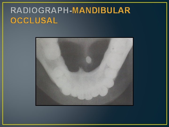 RADIOGRAPH-MANDIBULAR OCCLUSAL 