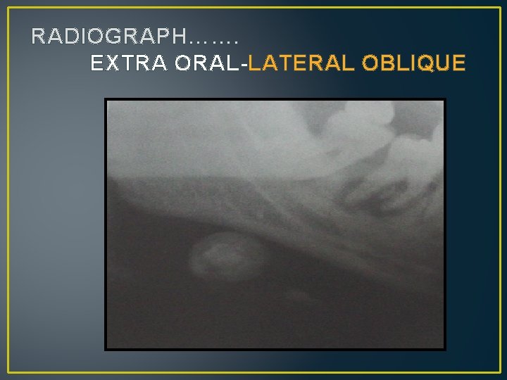 RADIOGRAPH……. EXTRA ORAL-LATERAL OBLIQUE 