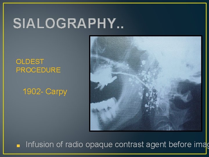 SIALOGRAPHY. . OLDEST PROCEDURE 1902 - Carpy Infusion of radio opaque contrast agent before