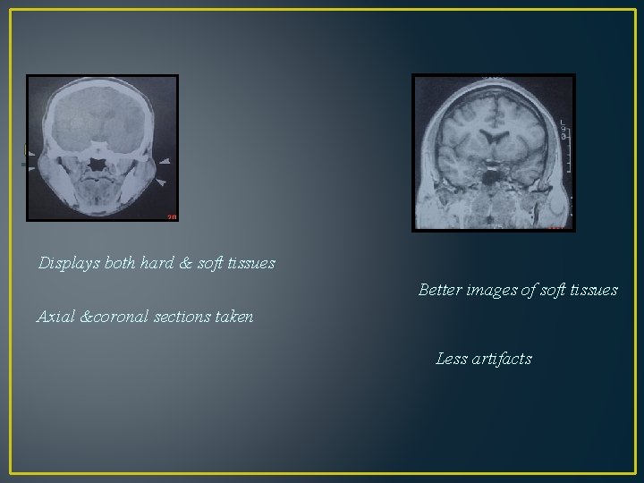 CT & MRI Displays both hard & soft tissues Better images of soft tissues
