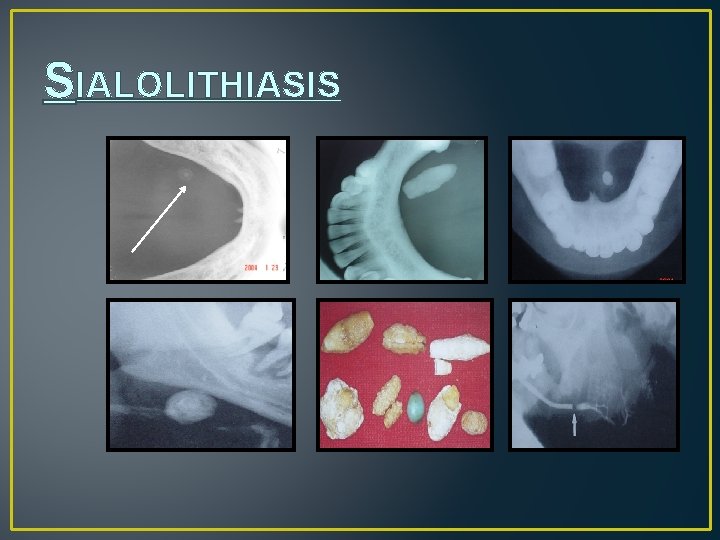 SIALOLITHIASIS 