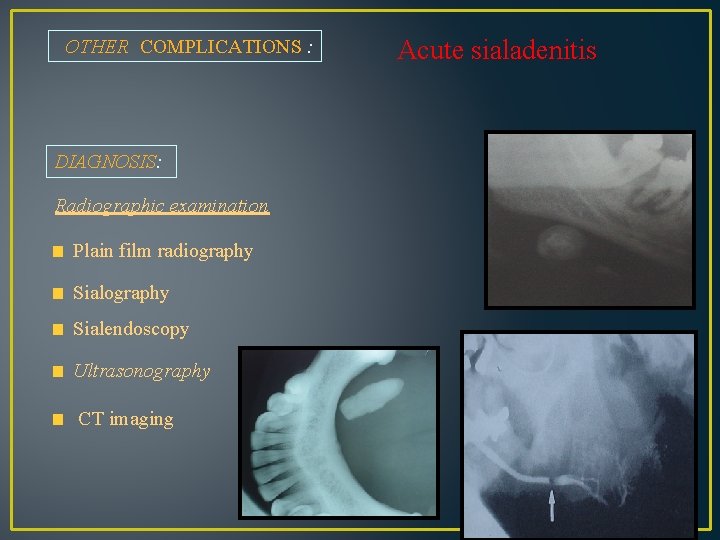OTHER COMPLICATIONS : DIAGNOSIS: Radiographic examination Plain film radiography Sialendoscopy Ultrasonography CT imaging Acute