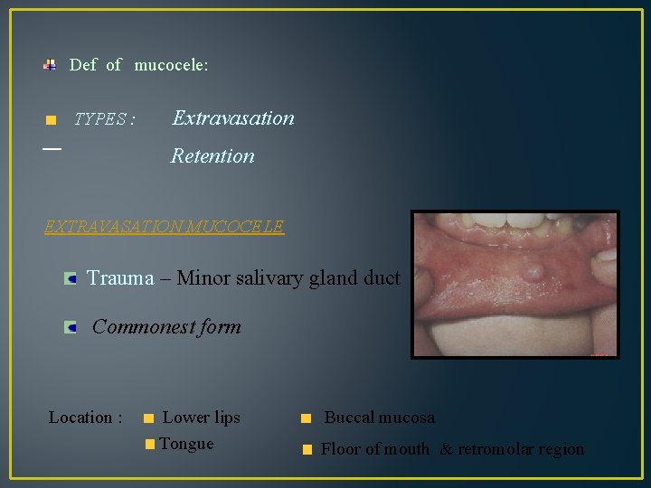 Def of mucocele: TYPES : Extravasation Retention EXTRAVASATION MUCOCELE Trauma – Minor salivary gland