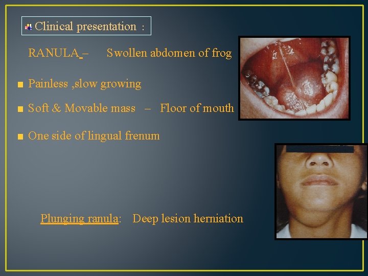 Clinical presentation : RANULA – Swollen abdomen of frog Painless , slow growing Soft