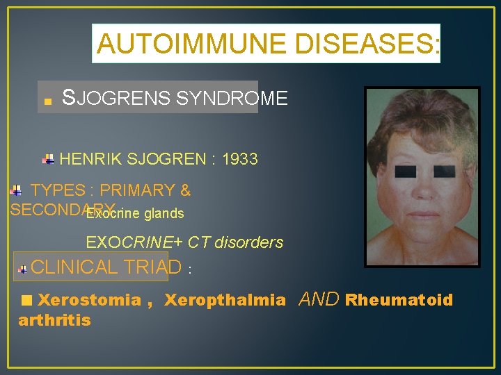 AUTOIMMUNE DISEASES: SJOGRENS SYNDROME HENRIK SJOGREN : 1933 TYPES : PRIMARY & SECONDARY Exocrine